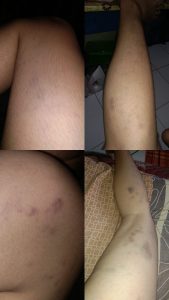 Mahasiswi UNUGO Diduga Jadi Korban Penganiayaan Oleh Sang Kekasih hingga Babak Belur